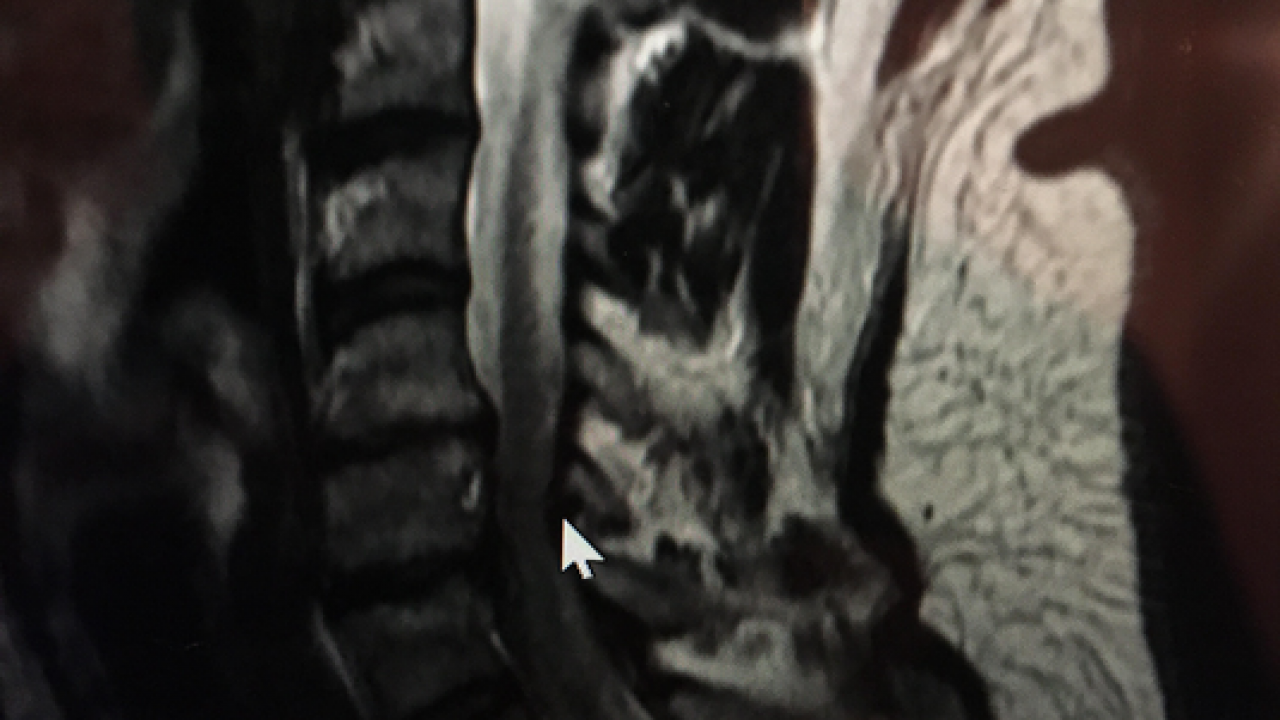 МРТ-знімок шийного відділу хребта Марата Кухара